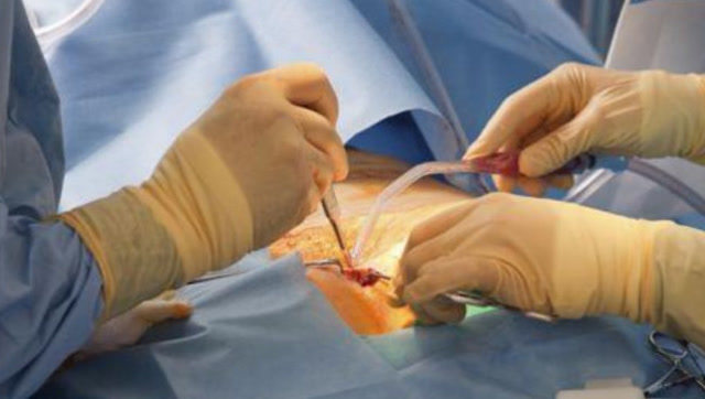 女性结扎对身体伤害有多大?看着都疼,真是太可怕了!