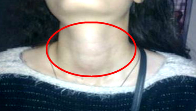 不止缺碘会诱发大脖子病,还有这3个原因,个个都不容小觑