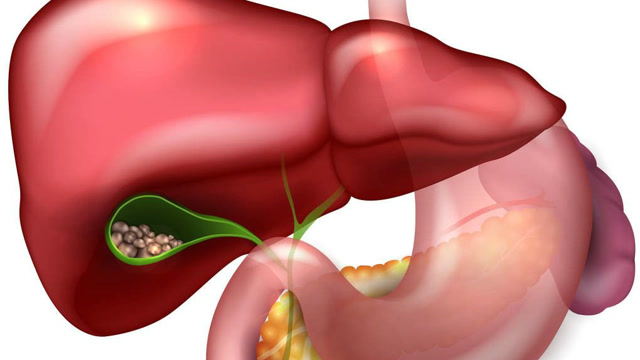 这4件事没做到的人,很容易患胆结石,别等生病之后再后悔