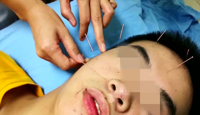 熬夜受凉后患上面瘫的小肖接受针灸治疗.
