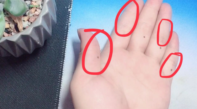 手指上长痣的人福气非常好一生贵人相助财运不断