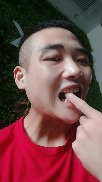 真的不要再吃槟榔了,我吃了19年的槟榔,目前张口只有一指