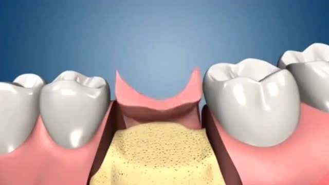 后槽牙的种植过程这只不过是一个模型演示吗所以大家要爱护好自己牙齿