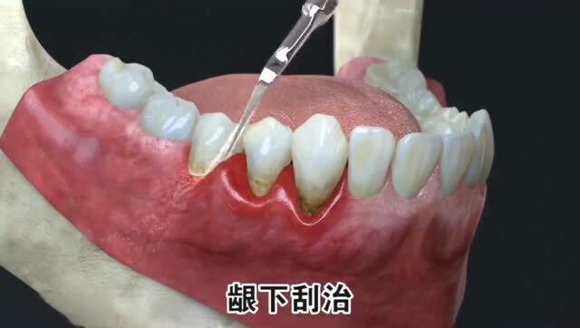 洗牙和龈下刮治有什么区别?