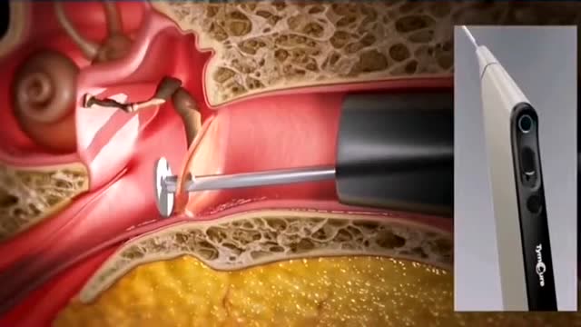 3d动画演示耳膜穿孔修补手术,原来还可以这样治,真是开眼界了!