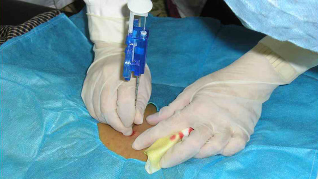 肾病患者必须做肾穿刺?不做行不行?