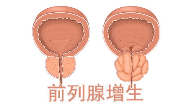 潘医生:根据前列腺增大的程度,可以把前列腺增生分三度