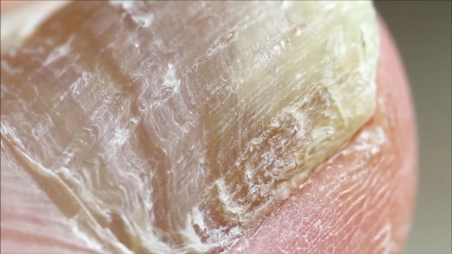 手指甲细菌显微镜下图片