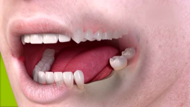 多颗牙齿缺失种植