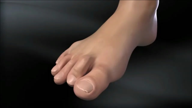 先天性锤趾症,手术治疗3d动画演示
