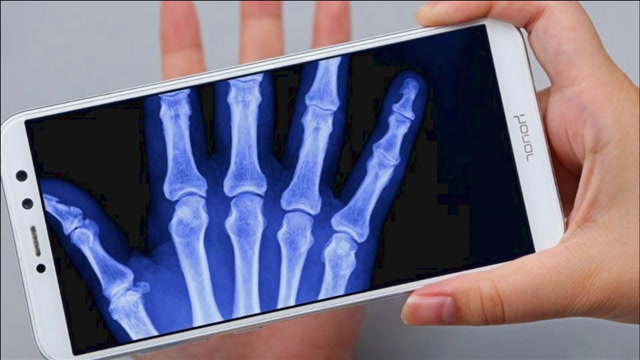 手机开启"ct扫描"功能,手掌上的骨骼清晰看到,太厉害了