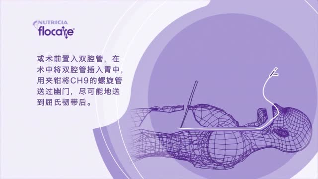 经鼻小肠减压管图片