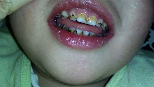 妈妈不让宝宝吃糖,宝宝却"一口黑牙"!这是为何?