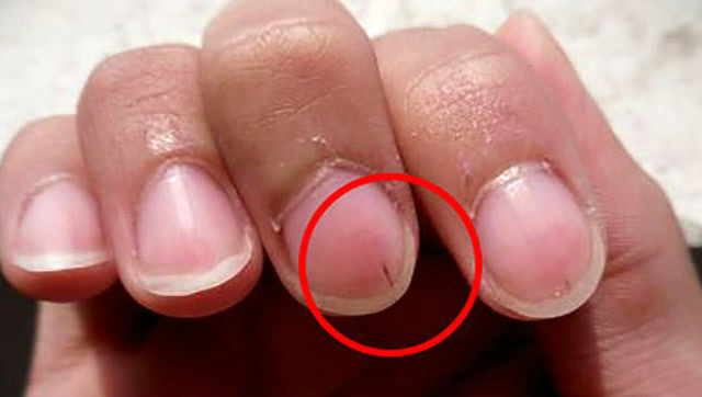 指甲上的这个现象是癌症的信号?让网友炸开锅了,可不能小看它呀