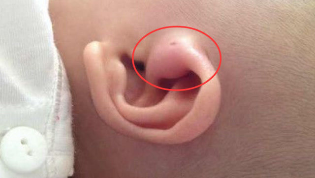 新生儿耳朵上有小孔,婆婆说是"富贵眼",大夫的解释让宝妈落泪!