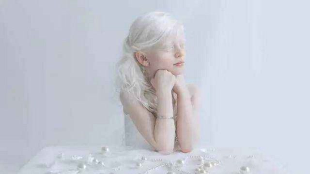 南非黑人歧视白人有多严重一家人得白化病全身变白被人歧视排挤