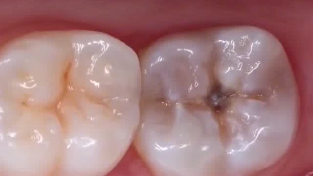 这就是牙齿内部的景象,外面看来只有一个小洞,其实里面已经坏了这么多