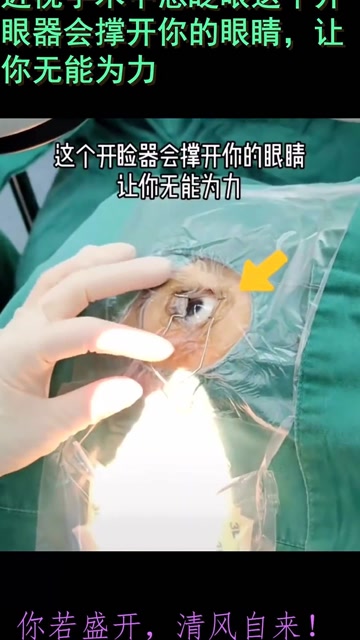 近视手术中想眨眼这个开眼器会撑开你的眼睛,让你无能为力