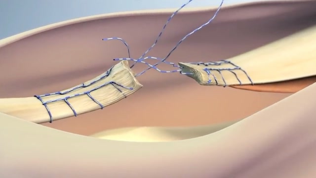 断筋是怎样复原的?用3d动画演示全过程,看完涨知识了