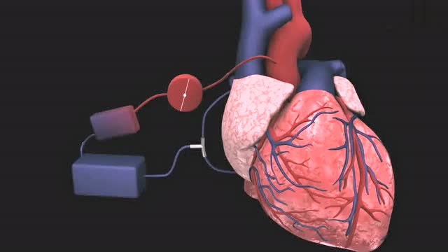 心脏搭桥动画演示过程图片