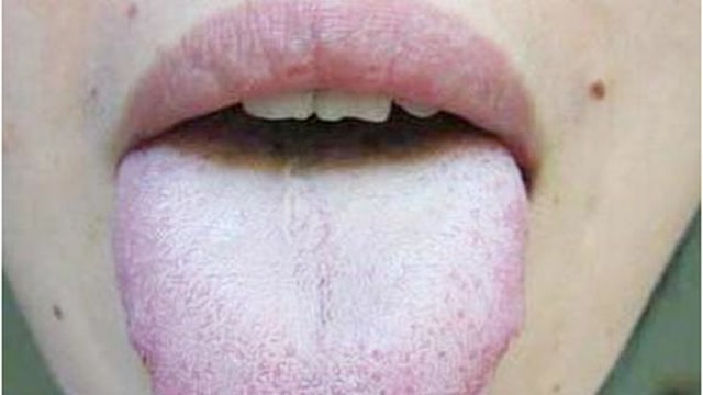 舌头有锯齿状 胃口不佳竟是湿气太重 教你一招不用吃药赶快祛湿