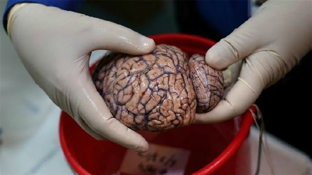 美国在银行存16000个人脑,专给脑瘫病人使用,你敢用吗?