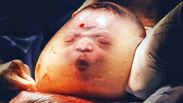 国外婴儿羊水未破出生,像一个小肉球,网友:哪吒转世?