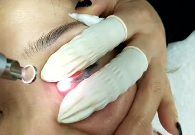 做了一个月的美瞳线怎么就晕色了,用激光清洗干净!