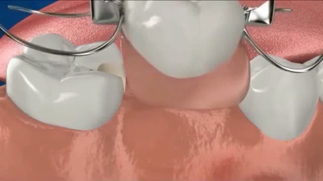 摘假牙套过程图解图片