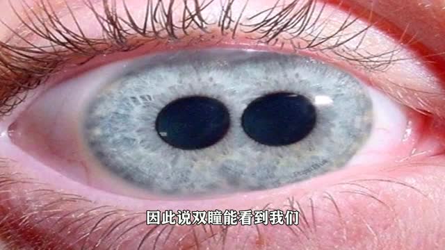 拥有"双瞳孔"的人,看到的世界究竟是什么样的?答案让人很意外