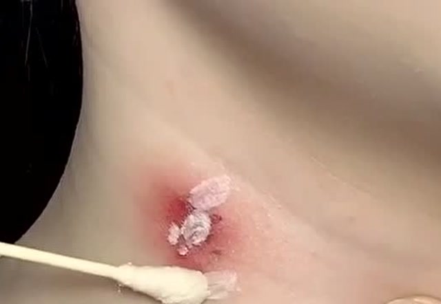 脖子上的草莓印这样就能处理掉了,轻轻一盖就没了,出门不尴尬了!