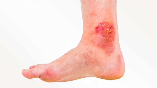 类风湿只有关节症状?出现紫癜,皮肤破溃要当心血管炎!