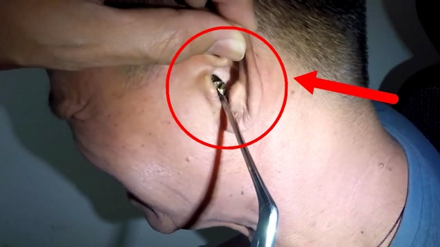 男子耳朵里钻进一只"不明生物",导致男子差点失聪,太可怕了!