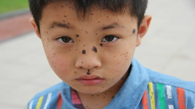 宝宝脸上的色素痣影响美观怎么办!恶变概率大吗?