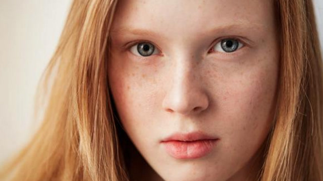 女人脸上长斑很难看坚持使用斑点就会去除还有美白的作用