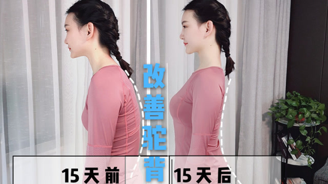 含胸驼背影响体态,真的不考虑纠正一下吗?