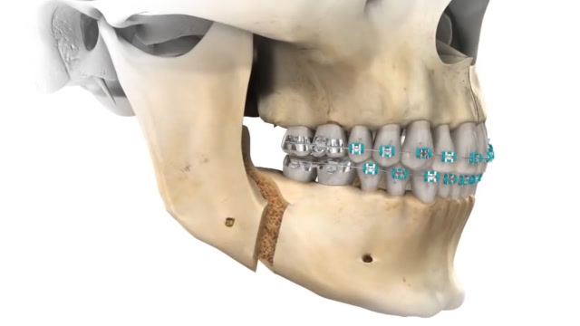 3d动画模拟面部削骨整容过程看完后你还敢去吗看着就疼