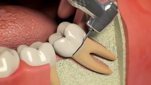 智齿大概就是这样拔除的,3d动画演示微创拔牙过程,工具效率果然很快!