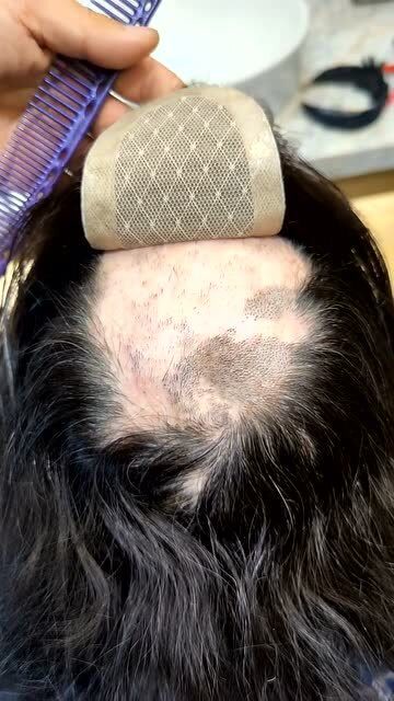 被烧伤的头皮戴假发,自信提升,终于不用自卑了!