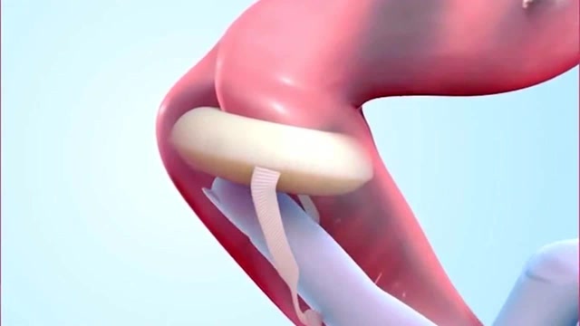 古代就有的避孕海绵这个安全措施你知道吗3d动画演示其原理