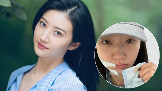 景甜拔智齿后首露面,右脸肿成包子气色憔悴,脱妆后鼻梁疤痕明显