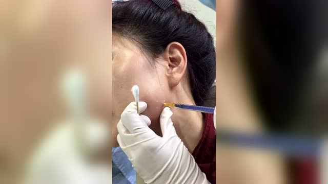 肉毒毒素注射咬肌视频