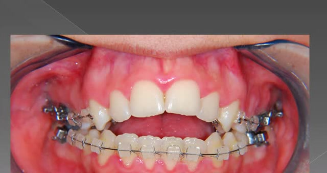 开颌矫正过程,可以让你完全闭嘴!