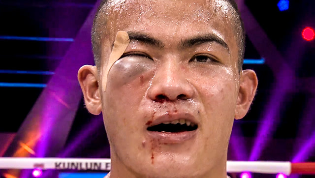 擂台最惨一幕!中国小将被重拳击脸,眼部肿胀如核桃一般大