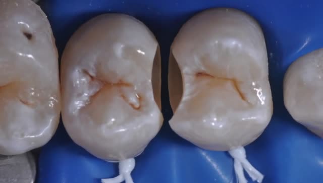 二类洞的微创预备与直接树脂修复