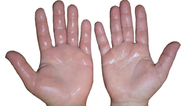 手上爱出汗竟是因为它?显微镜下放大1000倍,原来有猫腻!