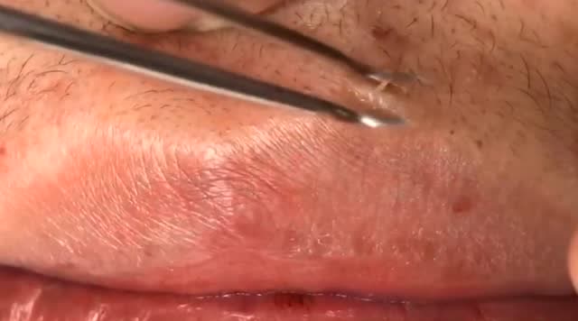 嘴角边都挤出这么多的黑头粉刺,一下子就干净多了,就是毛孔很大