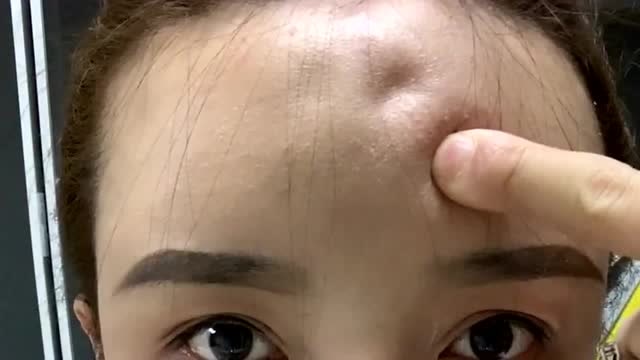 整容后遗症多奇葩,额头玻尿酸打多了以后,一按一个坑隔着屏幕我都害怕