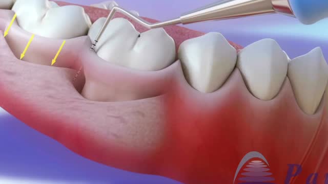 牙周病治疗—洁治加根面平整(京州口腔医院)