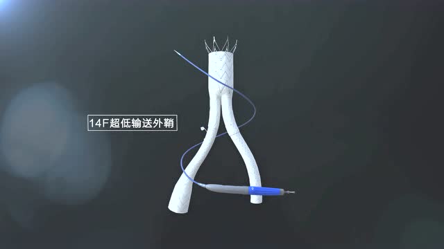 minos腹主动脉覆膜支架及输送系统